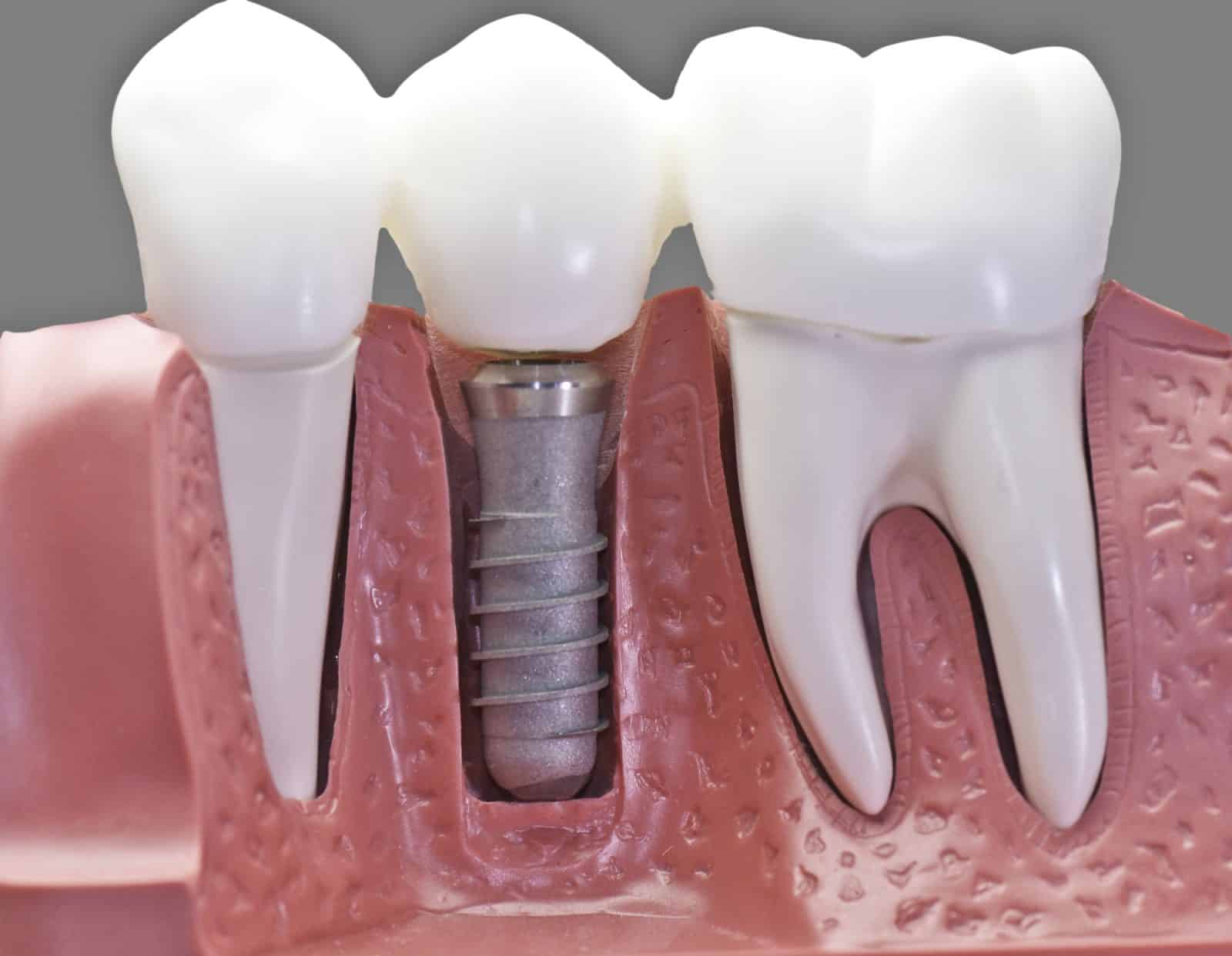 Implant dentaire : Pourquoi être opéré pour l’implant ?