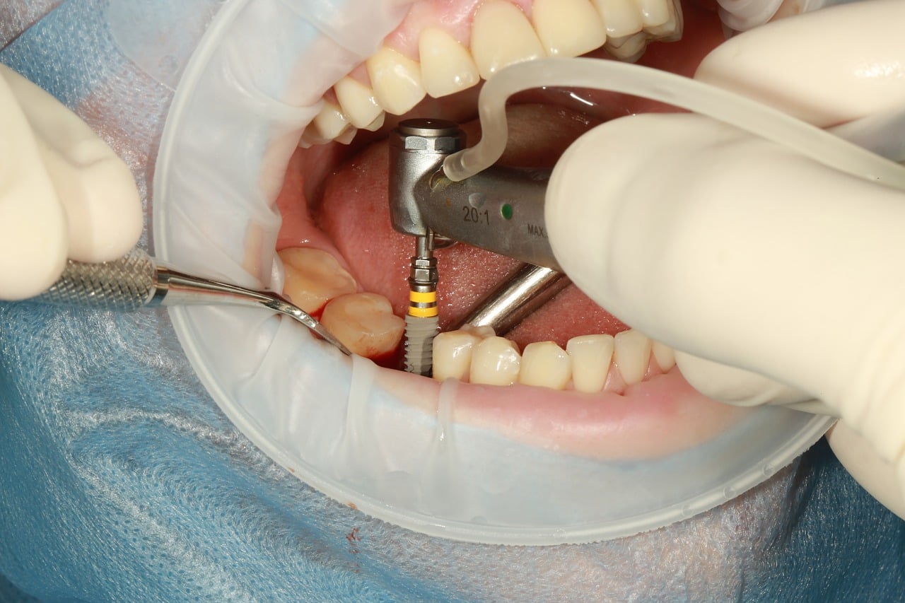 Implant dentaire : pourquoi la France l’adopte ?